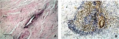 New Insights in Pathogenesis of Endometriosis